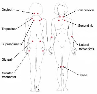 fibromyalgia pressure points - fms and cfs specialist in florida - dr dantini md